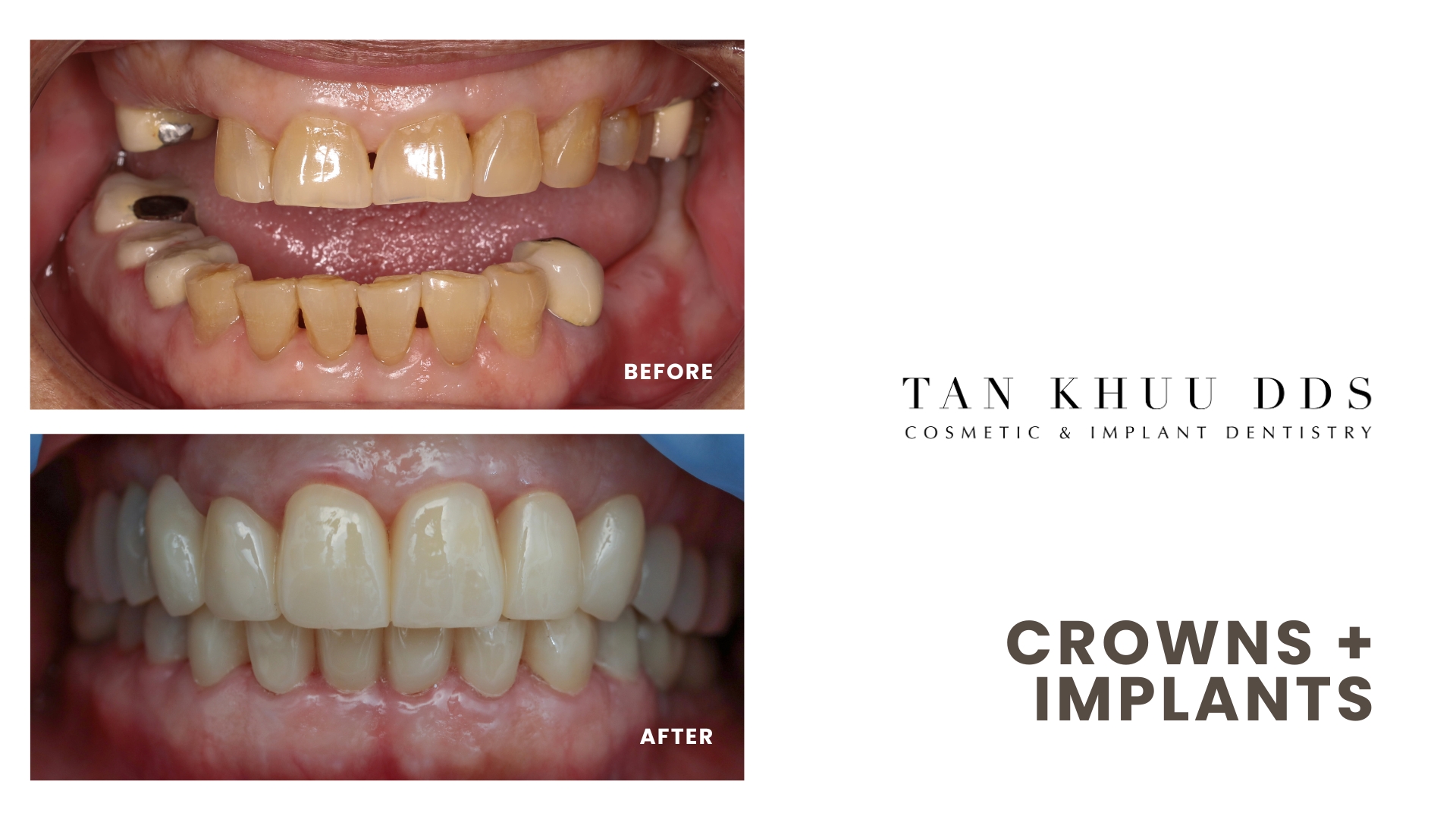 Implant crowns