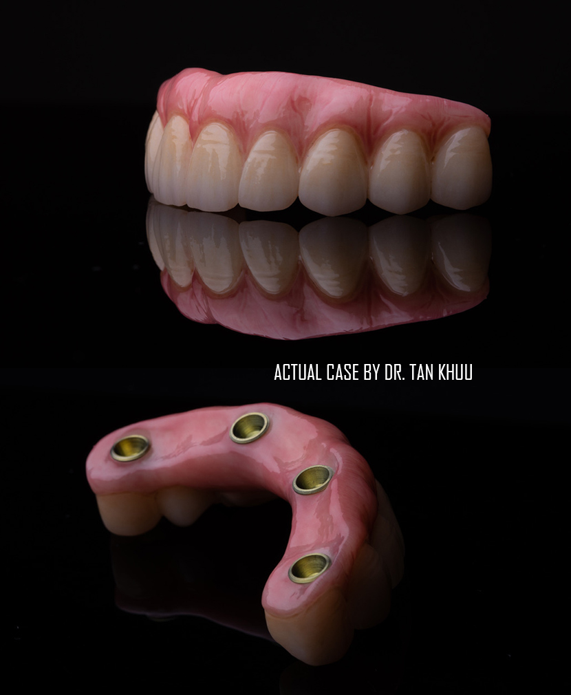All-on-X full-arch restoration