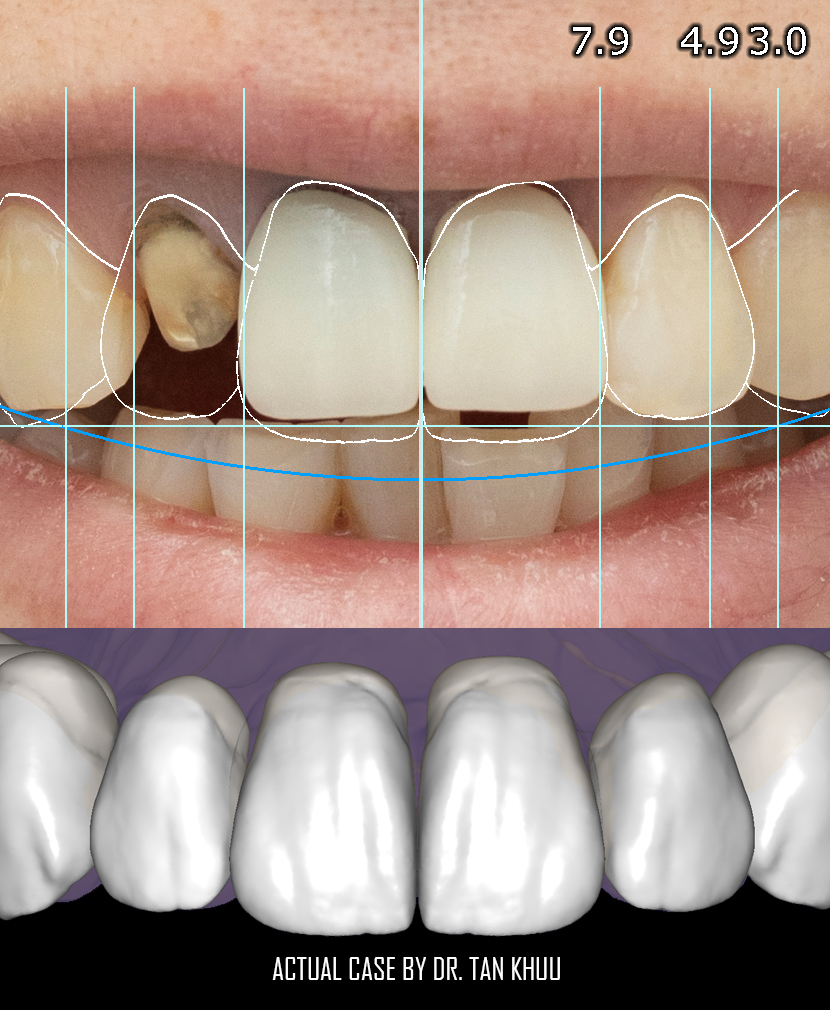 Cosmetic smile makeover