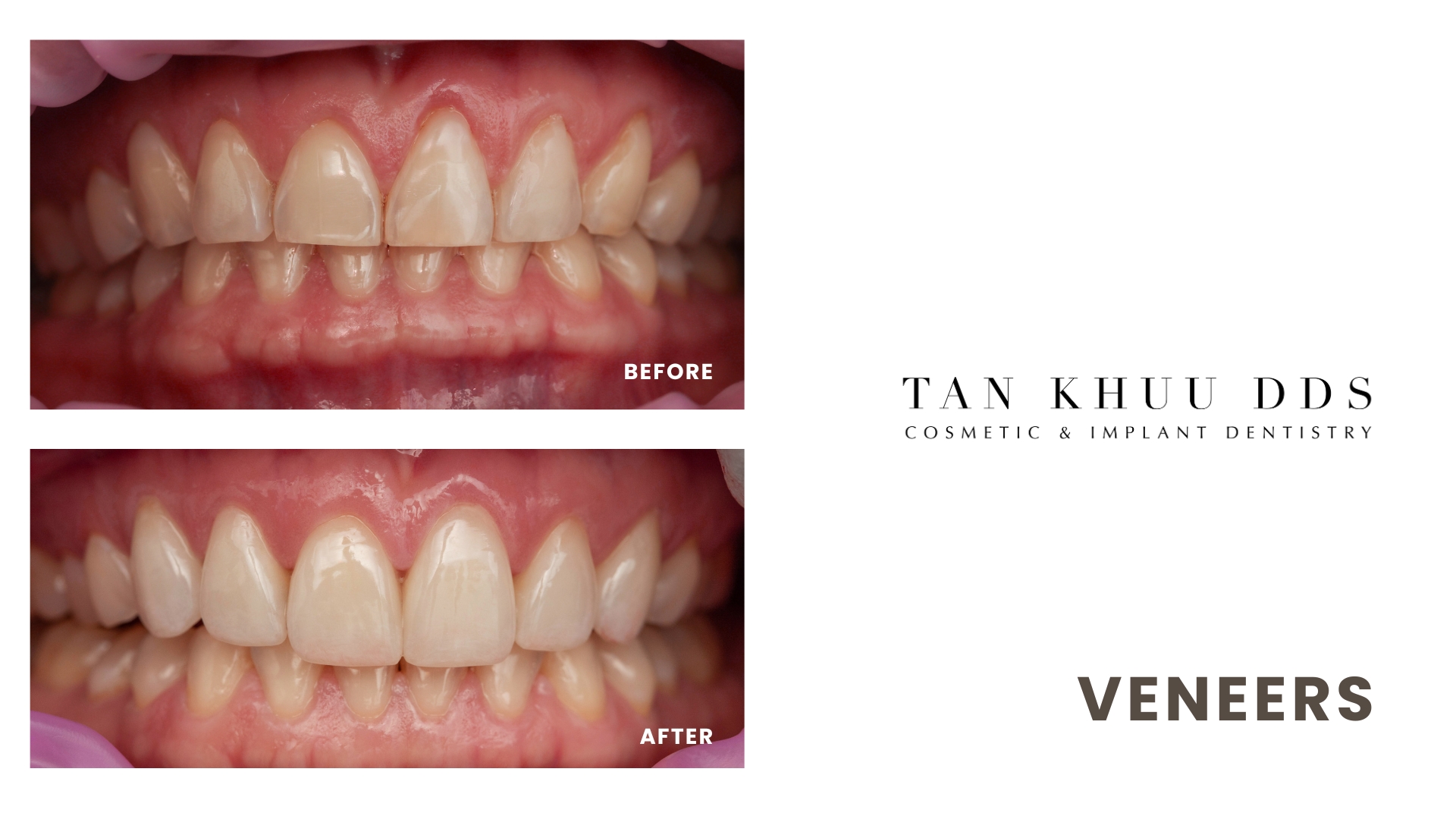 Veneers case