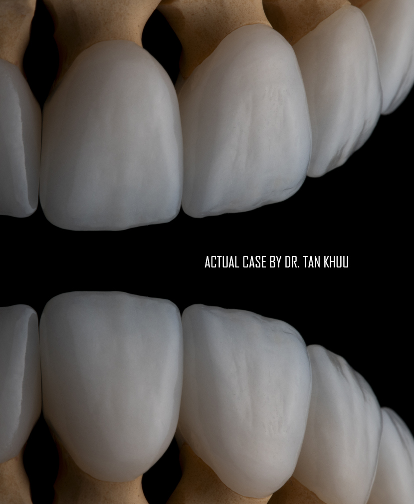 Porcelain veneers